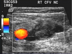 Vasculare Doppler (ultrasonografie) - scanare duplex vascular (UZDG) Doppler vasculară (ecografie) - recipiente de scanare duplex