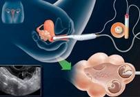 Fertilizarea in vitro (FIV) (in vitro) Fertilizarea in vitro (FIV)