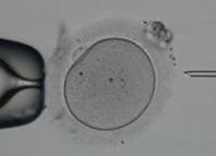 Fertilizarea in vitro (FIV) (în funcție de mai mulți factori) Fertilizarea in vitro (FIV)