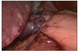 Fundoplicatură Nissen (gastroenterologie funcțional) fundoplicatură Nissen