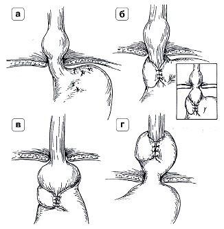 Fundoplicatură Nissen (literatură) fundoplicatură Nissen