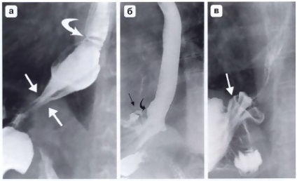 Fundoplicatură Nissen (medicament) fundoplicatură Nissen