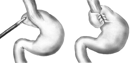 Fundoplicatură Nissen (intestin) fundoplicatură Nissen