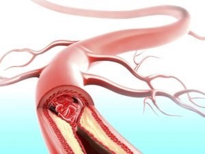 Hipertensiune arterială și diferențe mari ale tensiunii arteriale - ceea ce este diferența (diferența) Hipertensiune arterială și diferențe mari ale tensiunii arteriale - ceea ce este diferența