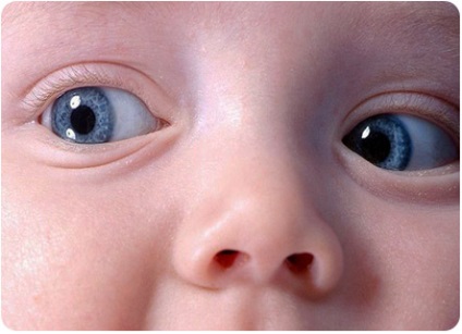 Glazik festers în neonate (nou-născut) Festers nou-născut glazik