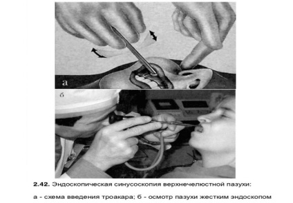 Cum și de ce pentru a efectua endoscopie nazală de diagnostic (de diagnostic) Cum și de ce pentru a efectua endoscopie nazală de diagnostic