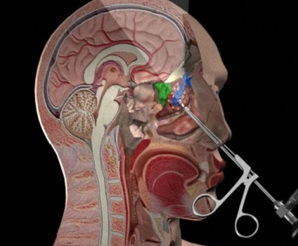 Cum și de ce pentru a efectua endoscopie de diagnostic a nasului (endoscopia nazala) Cum și de ce pentru a efectua endoscopie nazală de diagnostic