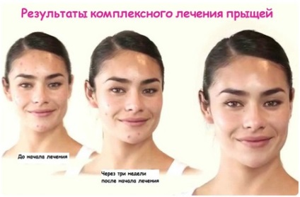 Indicații Laktofiltrum acnee, recenzii de aplicare (mărturii) Indicații acnee Laktofiltrum, comentarii aplicare