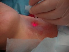 Tratamentul cu laser al tiroidei (tiroida) Tratamentul cu laser tiroidian