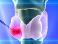 tratament cu laser tiroidian (tratament) Tratamentul cu laser tiroidian