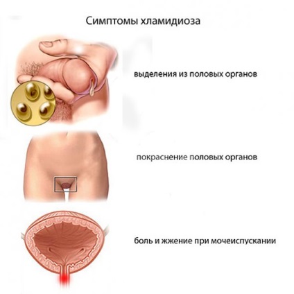 Tratamentul de remedii Chlamydia populare în casă (tratament) Chlamydia Tratament remedii populare la domiciliu