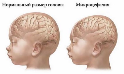 cap mic pentru boala, cauze si tratament (un volum mic al capului) cap mic pentru ca boala, cauze si tratament