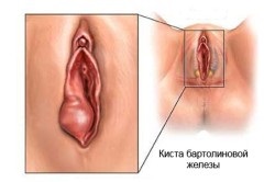 Marsupializatsiya Bartholin chisturile glandelor (Bartholin chisturi ale glandelor) chist glanda Bartholin Marsupializatsiya