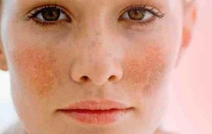 simptome melasma, cauze, metode de tratament (melasma) simptome melasma, cauze, tratament