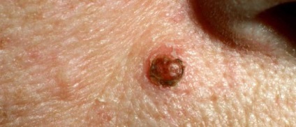 Melanoformny nev tehnicilor de eliminare, diagnosticare (tip intradermic) Melanoformny nev tehnici de eliminare, diagnosticare