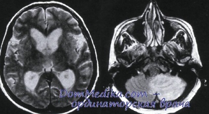 sindroame vasculare cerebeloase (Cardiovascular) sindroame vasculare cerebeloase