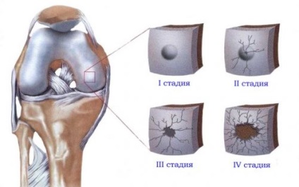 Genunchiere genunchi comune osteoartritei, ortopedice, cum de a alege, prețul (ortopedice) Genunchiere genunchi comune osteoartritei, ortopedice, modul de a alege, preț