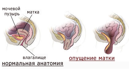 Omiterea a uterului cauze, simptome, efecte asupra stilului de viață (ptoză) Omiterea a uterului cauze, simptome, efecte asupra stilului de viață