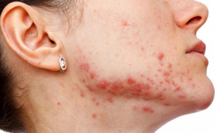Ostiofollikulit ce este, simptome, cum de a trata impetigo stafilococica a scalpului (a) Ostiofollikulit ce este, simptome, cum de a trata impetigo stafilococica a scalpului