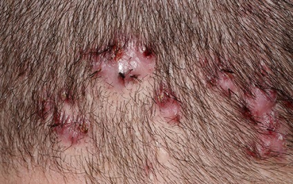 Ostiofollikulit ce este, simptome, cum de a trata impetigo stafilococica a scalpului (simptome) Ostiofollikulit ce este, simptome, cum de a trata impetigo stafilococica a scalpului
