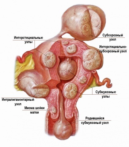 Diferențele leiomiom a uterului si fibrom uterin (uterin) leiomiomul Diferentele uterine si fibrom uterin