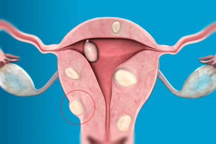 Diferențele leiomiom a uterului si fibrom uterin (uterin) leiomiomul Diferentele uterine si fibrom uterin