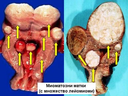 Diferențele leiomiom a uterului si fibroamele uterine (leiomioame) leiomiomul Diferentele uterine si fibrom uterin