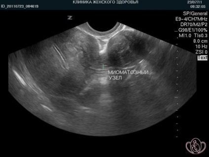 Diferențele leiomiom a uterului si fibrom uterin (miom) leiomiomul Diferentele uterine si fibrom uterin