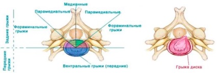 Paramediană hernie de disc L5-s1, altele hernii paramediană și tratamentul lor (ROM) Paramediană hernie de disc L5-s1, altele hernii paramediană și tratamentul acestora