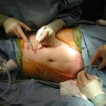 Transplantul de pancreas in raspunsurile de diabet (prostata) Transplantul de pancreas in comentarii diabet
