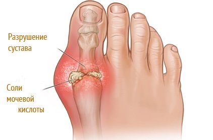 Pierderea de flexibilitate - primul semn al îmbătrânirii (îmbătrânire) Pierderea de flexibilitate - primul semn al îmbătrânirii