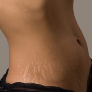 Microdermabraziunea Skinlazermed pentru a elimina în mod eficient vergeturi! (Microdermabraziunea) Microdermabraziunea Skinlazermed pentru a elimina în mod eficient vergeturi!