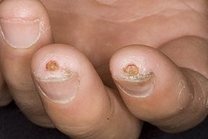 Sclerodermia - cauze, simptome si remedii populare tratamentul sclerodermiei (tratament remedii populare) Sclerodermia - cauze, simptome si remedii populare tratamentul sclerodermiei