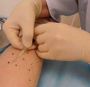 Scleroterapia venelor in tratamentul varicelor ale extremităților inferioare (varice) Scleroterapia venelor in tratamentul varicelor ale extremităților inferioare