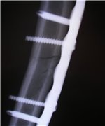 Placă de titan pe brațul, 2 răspunsuri, 43 comentarii, forum pentru sfaturi „Traumatologie și (cât de mult costă să pună o placă pe ciorchine în Bișkek. Plate în mână mă tem că nu este așa. Cineva a pus în placă de titan Novosibirsk RITO în osul radial și a scos? cum te simți. după cum puteți merge cu un ac de titan în mână. trebuie să plătesc pentru o placă în timpul intervenției chirurgicale pe humerusului. plăci de titan în mână. dacă este posibil să meargă mult timp cu ace tittanovymi în mână. cât de mult se poate merge pe jos, cu spițe de titan în mână. de ce poate văita mână a plăcii inserate. Intervențiile chirurgicale realizate sub placa de titan anestezie pe antebraț. In unele cazuri, se rupe plastna la îndemână. fractura de deplasare os inserție placă. placă de titan în umăr și sport său. Records tarif pentru un braț rupt. dacă este posibil să se meargă cu o placă în mână. greu de îndepărtat placă în mână. plastinav umăr nu a lipi. pus o farfurie în mână o febră. chereh cât de mult timp va vindeca pomle mana inserarea de titan încheietura mâinii pe forum otzyay plvstiny. cot cum să se dezvolte în cazul în care placa în picioare pe humerus) Placă de titan pe brațul, 2 replici, 43 comentarii, consultarea-Forum „și traumatologie
