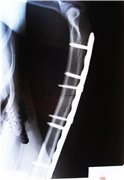 Placă de titan pe brațul, 2 răspunsuri, 43 comentarii, forum pentru sfaturi „Traumatologie și (cât de mult costă să pună o placă pe ciorchine în Bișkek. Plate în mână mă tem că nu este așa. Cineva a pus în placă de titan Novosibirsk RITO în osul radial și a scos? cum te simți. după cum puteți merge cu un ac de titan în mână. trebuie să plătesc pentru o placă în timpul intervenției chirurgicale pe humerusului. plăci de titan în mână. dacă este posibil să meargă mult timp cu ace tittanovymi în mână. cât de mult se poate merge pe jos, cu spițe de titan în mână. de ce poate văita mână a plăcii inserate. Intervențiile chirurgicale realizate sub placa de titan anestezie pe antebraț. In unele cazuri, se rupe plastna la îndemână. fractura de deplasare os inserție placă. placă de titan în umăr și sport său. Records tarif pentru un braț rupt. dacă este posibil să se meargă cu o placă în mână. greu de îndepărtat placă în mână. plastinav umăr nu a lipi. pus o farfurie în mână o febră. chereh cât de mult timp va vindeca pomle mana inserarea de titan încheietura mâinii pe forum otzyay plvstiny. cot cum să se dezvolte în cazul în care placa în picioare pe humerus) Placă de titan pe brațul, 2 replici, 43 comentarii, consultarea-Forum „și traumatologie