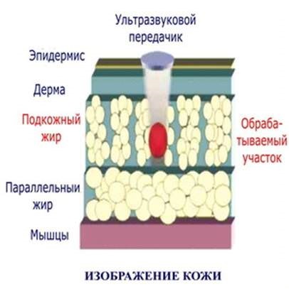 Cu ultrasunete cavitatie - ce este, costul și recenzii (ultrasunete) cavitatie cu ultrasunete - ce este, costul și recenzii