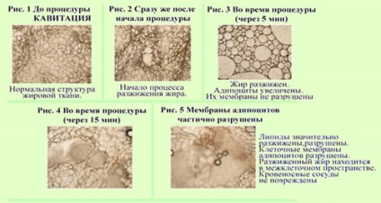 Cu ultrasunete cavitatie - ce este, recenziile de cost și (cost) cavitatie cu ultrasunete - ce este, costul și recenzii