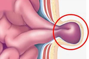 Strangulată simptome, semne de hernie inghinală, complicații, de îngrijire acută (hernie) Strangulată simptome hernie inghinală, semne, complicații, asistență medicală de urgență