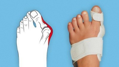Hallux anvelope - banda de noapte (banda) Valgus atelă - noapte bandaj