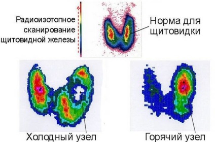 nod la cald și la rece tiroidian, care este simptomele, tratamentul (prostată) nodul tiroidian la cald și la rece, care este simptomele, tratamentul