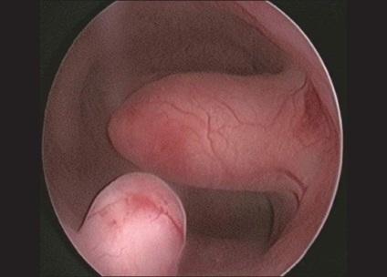 polip endometrial glandulară (endometru) polip endometrial glandulara