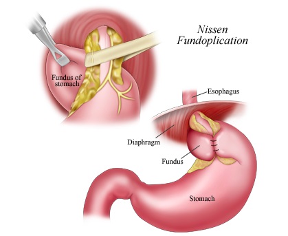 reflux gastroesofagian și boala de reflux gastroesofagian la copii (Departamentul de Chirurgie Toracica si Gastroenterologie chirurgicale) reflux gastroesofagian și boala de reflux gastroesofagian la copii