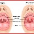 Simptomele streptococcus beta-hemolitic și tratament (simptome) Simptomele streptococi beta-hemolitic și tratament