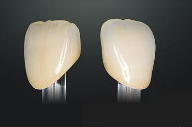 Ceramica estetica, siguranta, biocompatibilitate (fiabilitate) Ceramica estetica, fiabilitate și biocompatibilitate