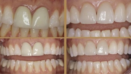 Ceramica estetica, siguranta, biocompatibilitate (estetica) Ceramica estetica, fiabilitate și biocompatibilitate