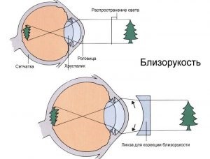 Miopiei la copii de vârstă școlară (copii) Miopiei la copii de vârstă școlară