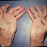 Mă doare mâna în flexie ce să facă, cum să trateze (cu perii) Hurts mâna în flexie ce să facă, cum să trateze