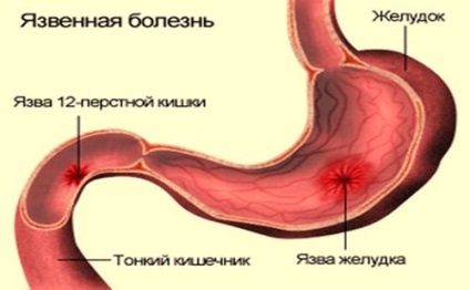 Durere sub marginea din stânga se poate obține dureri de rău sub marginea din stânga din față și din spate (stânga) Durere sub marginea din stânga se poate obține dureri de rău sub partea din față stânga și marginea posterioară
