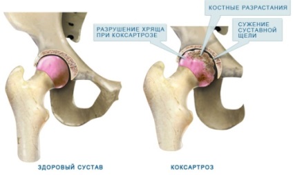 Deformând sold osteoartrita (doa) 1, 2, 3 grade cauze, simptome, tratament (osteoartrita) Deformând osteoartrita sold (doa) 1, 2, 3 grade cauze, simptome, tratament